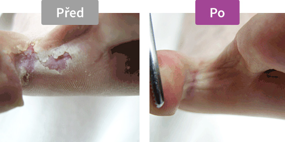 Footlogix Peeling Skin Formula (7) - Pěna pro loupající se pokožku, 125 ml - před. / po