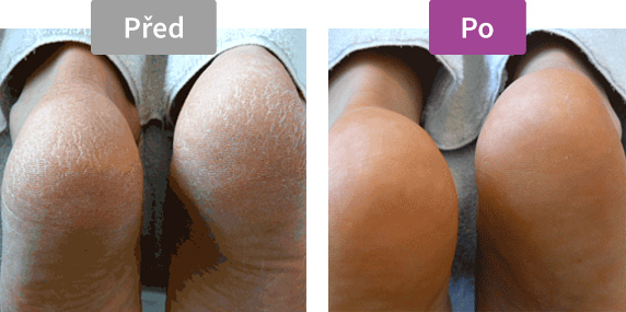 Footlogix Very Dry Skin Formula (3) - Pěna pro velmi suchou pokožku - před / po