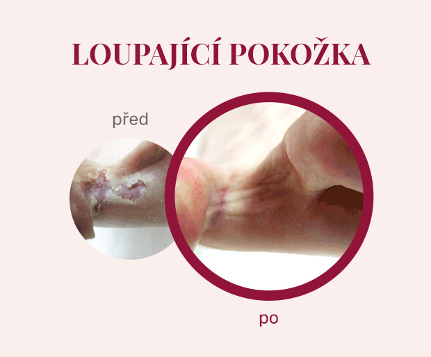 Footlogix - léčba loupající pokožky