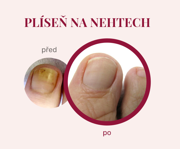 pedikura-footlogix-ucinky_02-plisen Footlogix - léčba plísně na nehtech